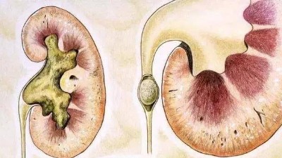 腎結石是怎么引起的？