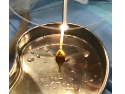 雅安仁康醫院保膽取石手術