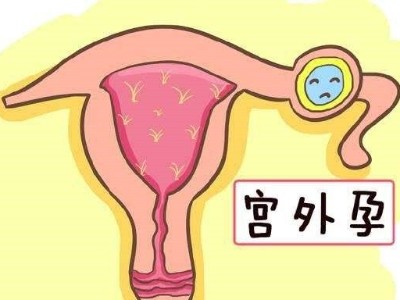 宮外孕（異位妊娠）