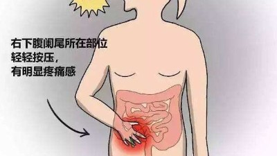 慢性闌尾炎需要切除嗎？